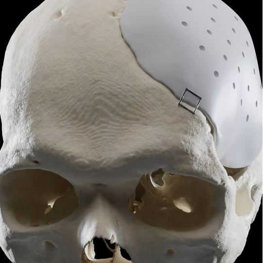 Massgefertigte Implantate für chirurgische Perfektion